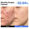 Hot ABC Triple-synergy Redness Comfort Serum Alle Korean Skincare|Anti-Unreinheiten-Serum