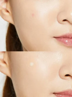 Best Acne Pimple Master Patch Original Fit Alle Korean Skincare|Pickelpflaster