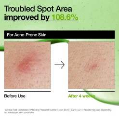 New Azelaic Acid 10 Hyaluron Redness Soothing Serum Hauptzutat|Anti-Unreinheiten-Serum