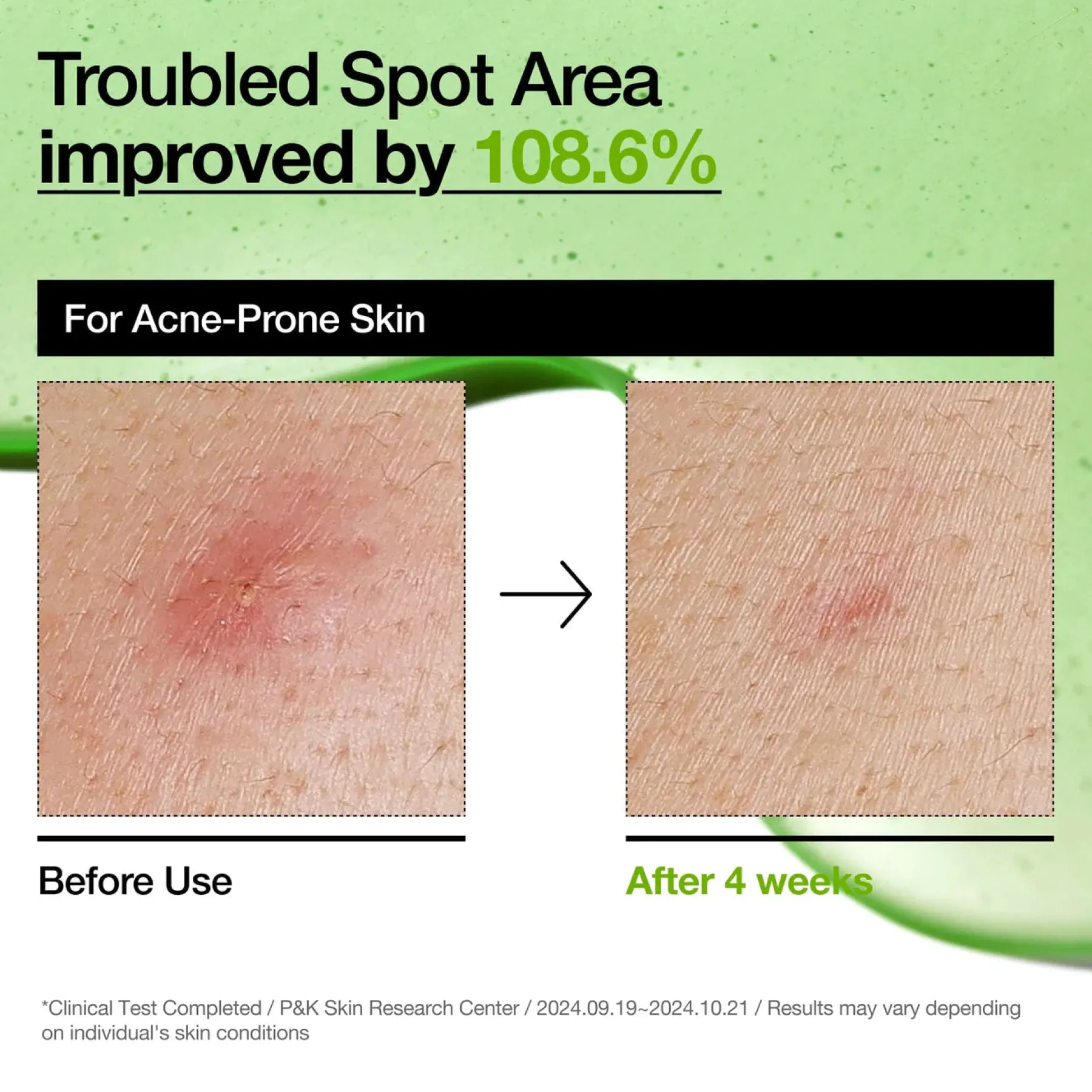 New Azelaic Acid 10 Hyaluron Redness Soothing Serum Hauptzutat|Anti-Unreinheiten-Serum