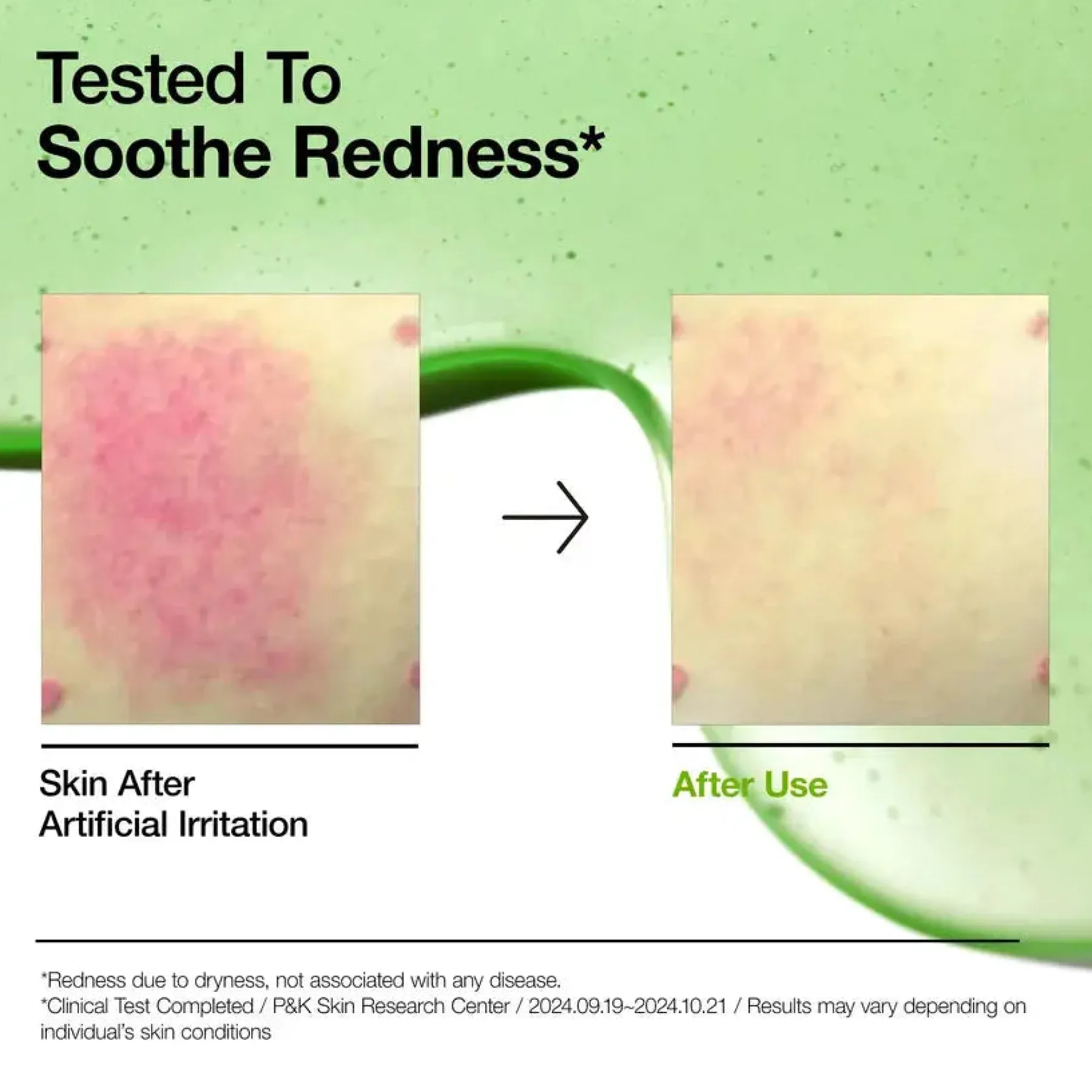 New Azelaic Acid 10 Hyaluron Redness Soothing Serum Hauptzutat|Anti-Unreinheiten-Serum