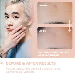 Online Emergency Dots For Spots and Blemishes Salicylic Acid Vegan Pflege|Hauptzutat