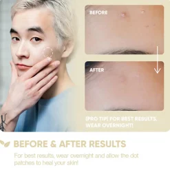 Discount Emergency Dots For Spots Niacinamide and Zinc Vegan Pflege|Hauptzutat