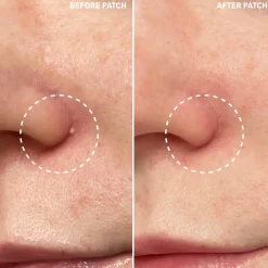 Clearance Hydrocolloid Invisible Pimple Patches Vegan Pflege