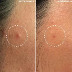 Clearance Hydrocolloid Invisible Pimple Patches Vegan Pflege