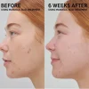 Discount Mandelic Acid Treatment Vegan Pflege