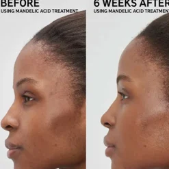 Discount Mandelic Acid Treatment Vegan Pflege