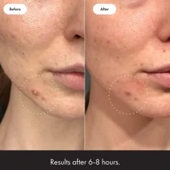 Outlet Mighty Patch Invisible Alle Korean Skincare|Pickelpflaster