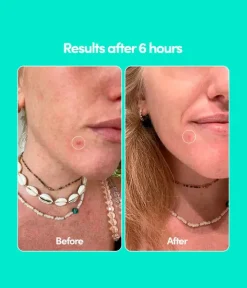 Outlet Pimple Patches Vegan Pflege|Hautprobleme
