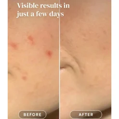 Discount Post Pimple Patches Vegan Pflege|Pickelpflaster