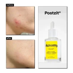 Hot Postzit Zit Marks Solutions Vegan Pflege
