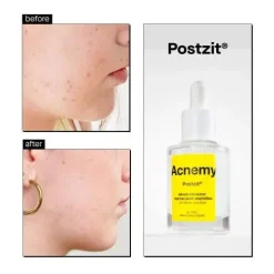 Hot Postzit Zit Marks Solutions Vegan Pflege