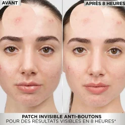 Discount PureActive Pimple Patch Vegan Pflege|Hautprobleme