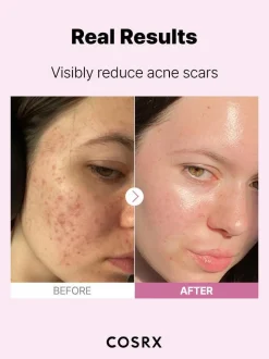 Sale The Niacinamide 15 Serum Hauptzutat|Anti-Unreinheiten-Serum